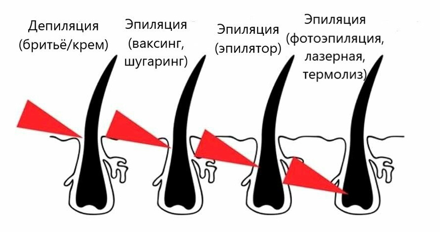 эпиляция и депиляция