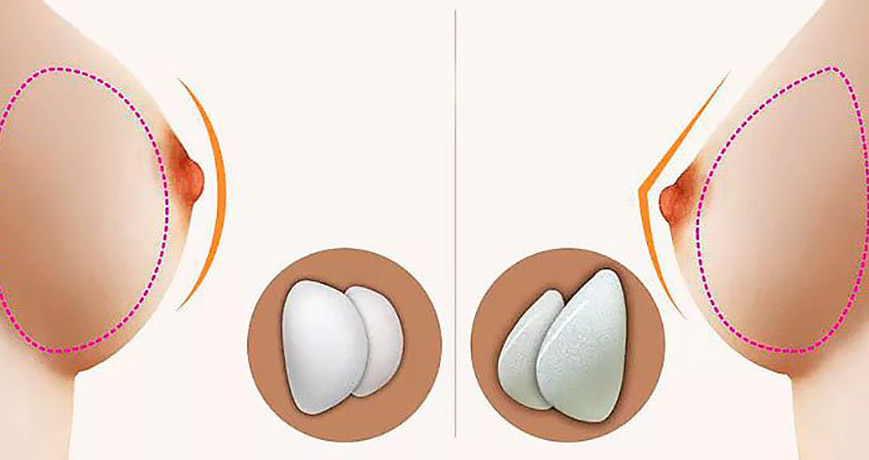 Анатомические и круглые импланты