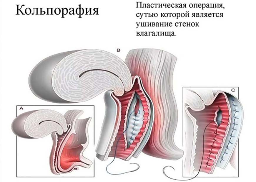 Кольпорафия - операция по коррекции размера влагалища