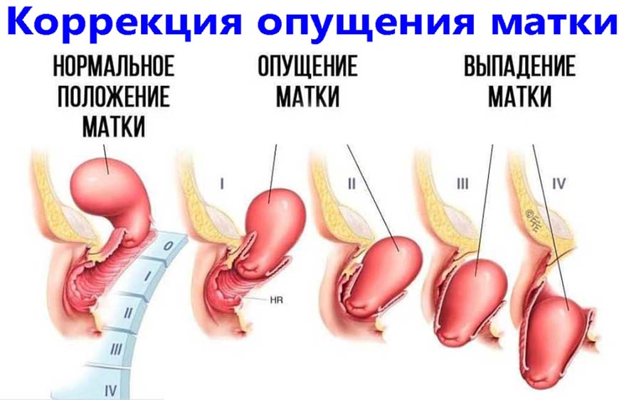 Опущение матки как показание к кольпорафии