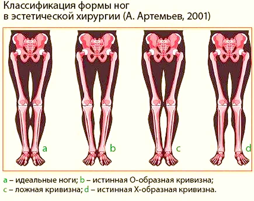 Типы искривления ног