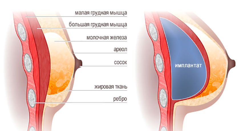 Увеличение груди имплантами