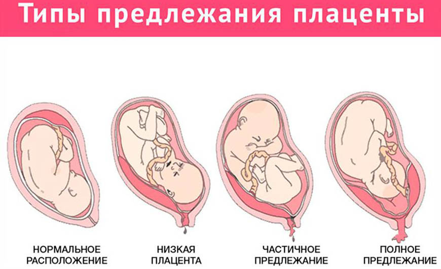 Предлежание плаценты