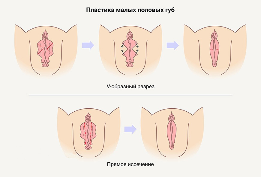 Пластика половых губ