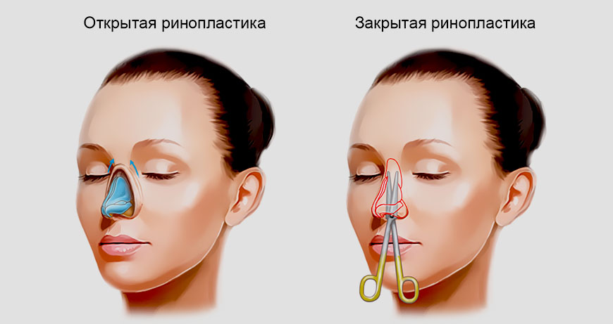 Открытая и закрытая ринопластика