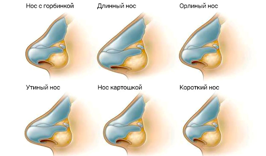 Ринопластика позволяет исправить форму носа