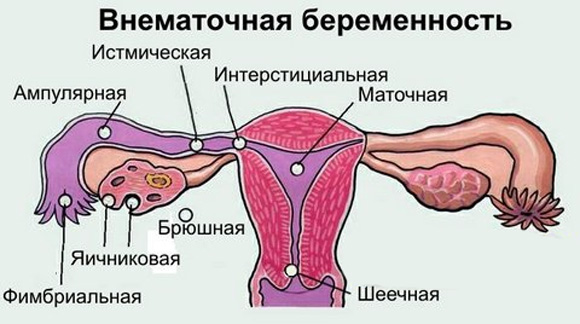 Виды внематочной беременности