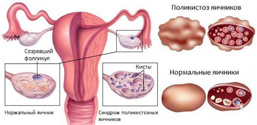 Поликистоз яичников